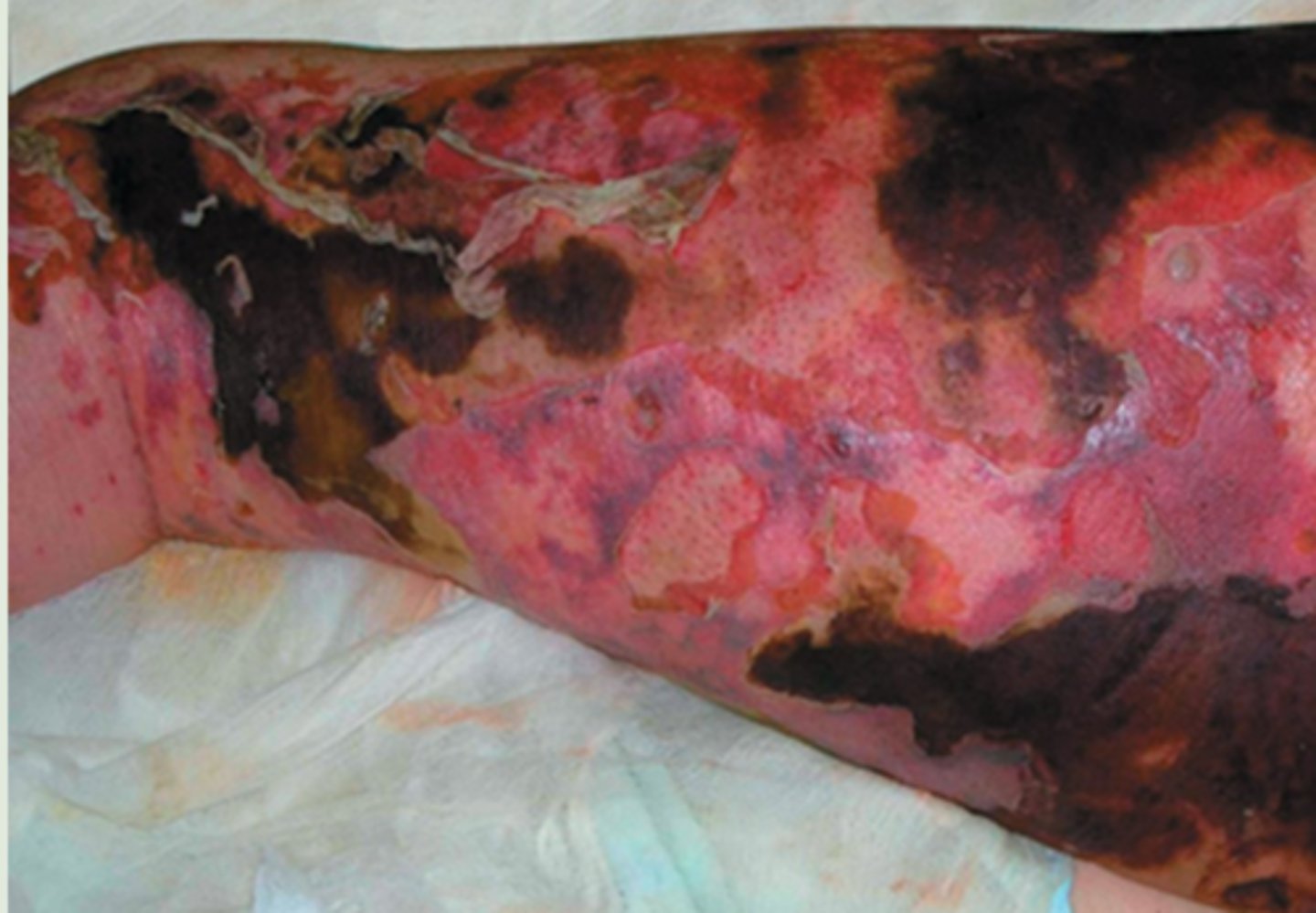 <p>necrotizing fasciitis</p>