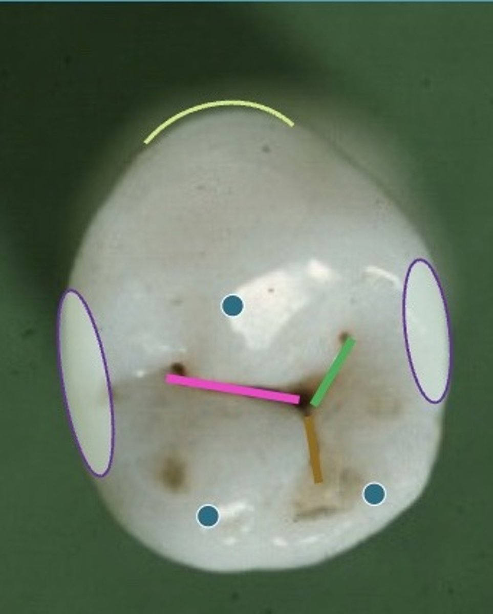<p>cusp variant may <strong><span style="text-decoration:underline">diverge</span></strong> toward the lingual creating smaller lingual embrasures</p>