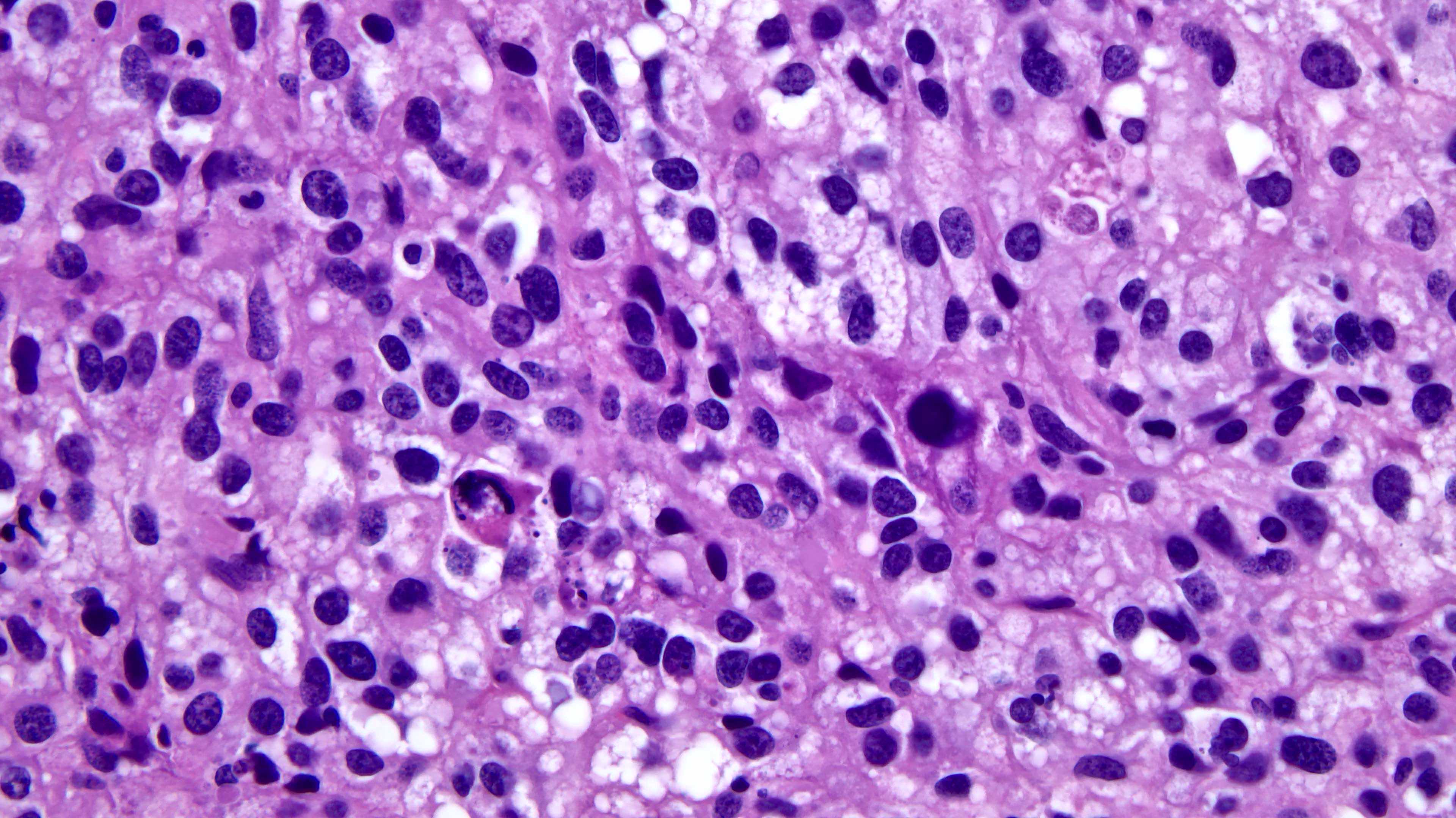 <p>Abnormal cells</p>