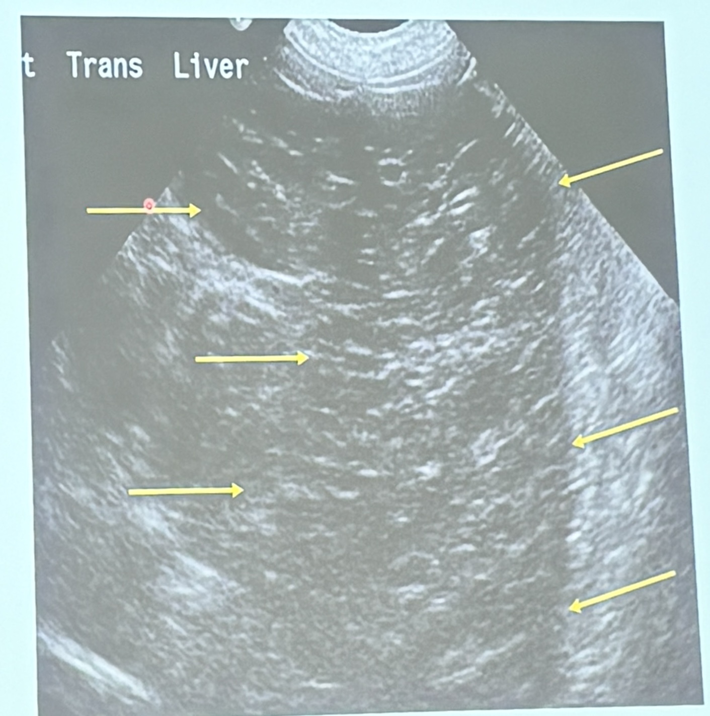 <p>This is a longitudinal scan of the liver from an 8yo MN MBD diagnosed with lymphoma. What are the ultrasonographic findings?</p>