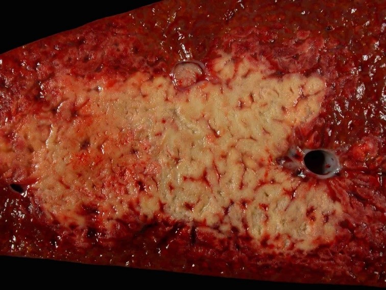 <p><span><span>The image depicts liver from a horse. In this type of necrosis, protein denaturation predominates over enzymatic digestion and grossly (macroscopically), the tissue is paler in color, is often firm, and may be swollen or shrunken. This is an example of what type of necrosis?</span></span></p><p>Coagulation (coagulative) necrosis</p><p>&nbsp;</p><p>Caseous necrosis</p><p>&nbsp;</p><p>Liquefactive (lytic) necrosis</p>