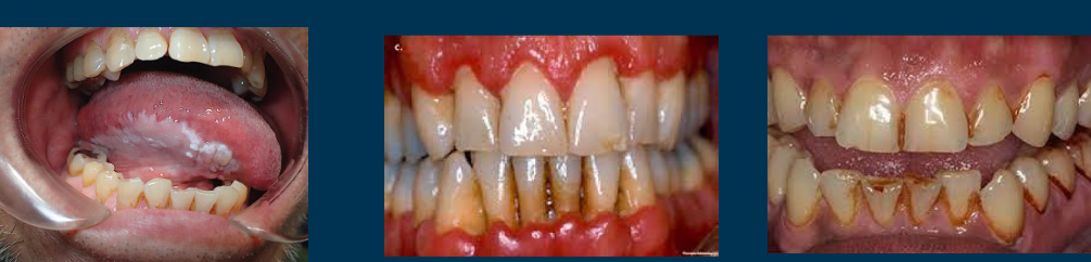 <p><span>• Weakened response to conventional therapy </span></p><p><span>• Negative effect on bone regeneration after periodontal therapy </span></p><p><span>• Increased risk of implant failure </span></p><p><span>• Delayed healing</span></p>