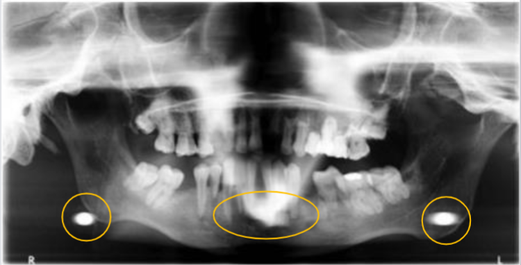 <p>what zone is this in of the focal trough? is it real or a ghost image or a double image </p>