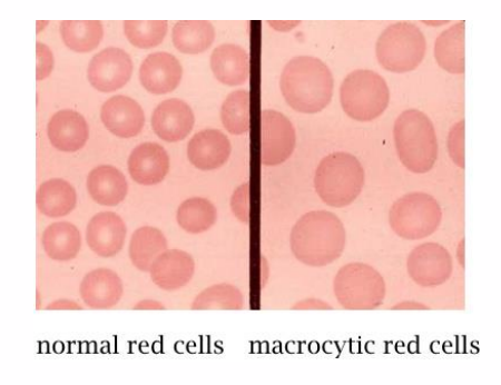 <p>Folate (Vitamin B9) Deficiency: Macrocytic Anemia</p>