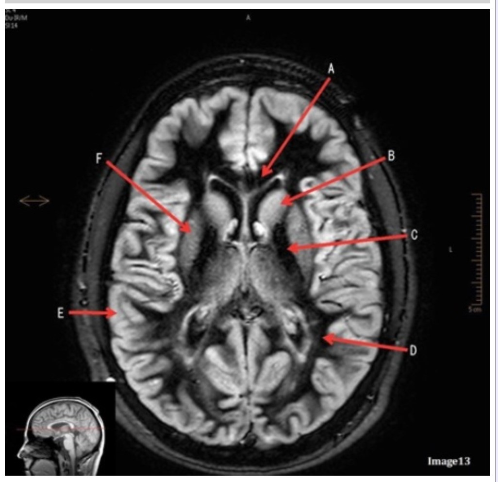 <p><span><strong>Letter C in Image 13 is pointing to:</strong></span></p><p><span>A. Splenium of the corpus callosum</span></p><p><span>B. Genu of the corpus callosum</span></p><p><span>C. Lentiform nucleus</span></p><p><span>D. Caudate nucleus</span></p><p><span>E. Internal capsule</span></p>