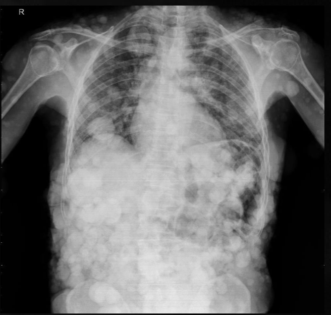 <p>what is seen here for this case of neurofibromatosis type 1?</p>