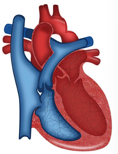 __**● Defect:**__  

○ Narrowing of the aorta  

○ Impedes blood flow to the lower half of the body  

__**● History:**__  

○ Symptoms appear quickly  

■ When ductus arteriosus closes can rapidly  progress to hypotension, acidosis, shock, and  death.