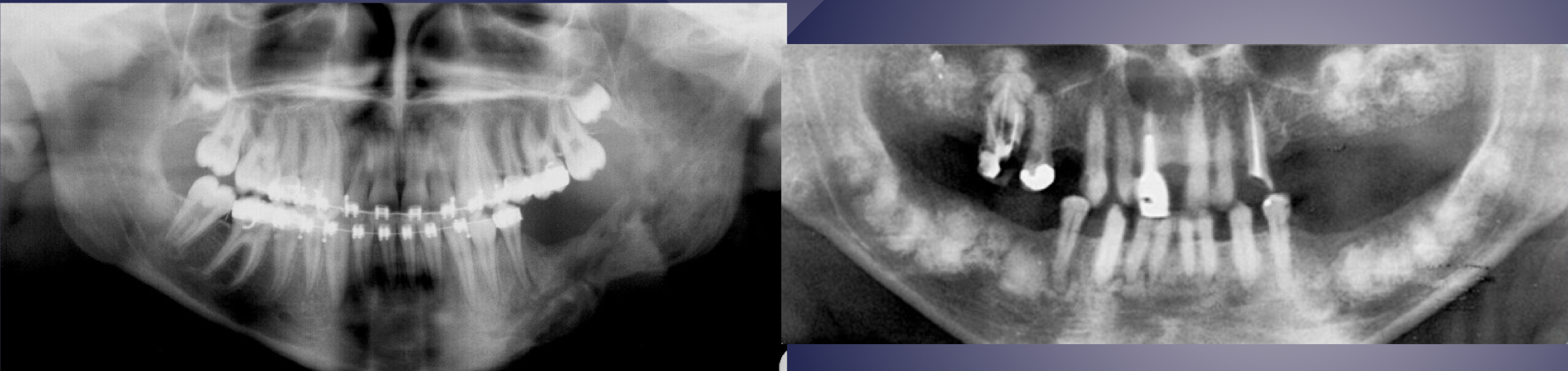 <p>which is osteomyelitis?</p>