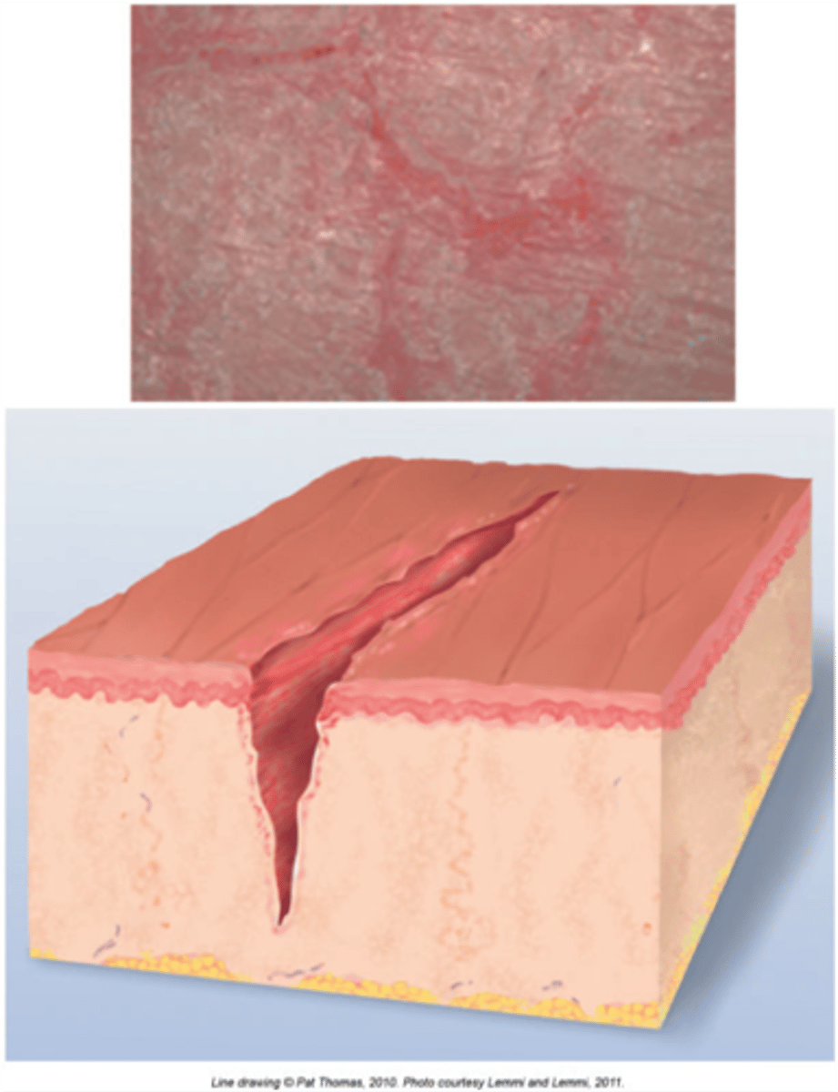 <p>a linear crack in the skin</p>