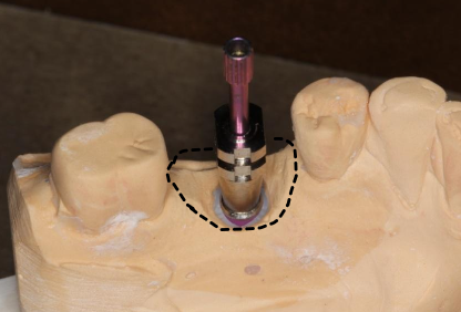 <p>What is the third step to fabricating a provisional implant restoration?</p>