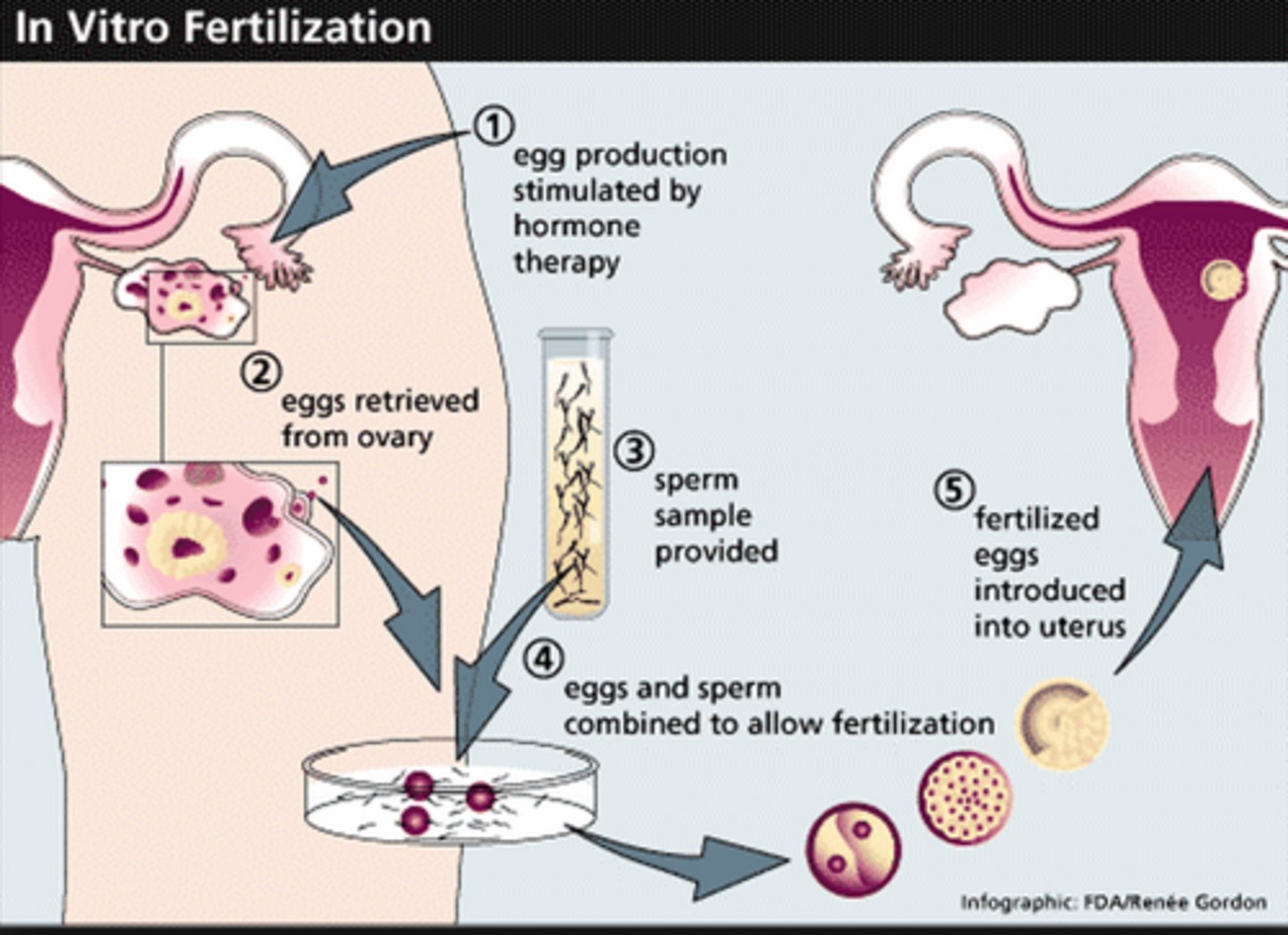 <p>1 - mother is given FSH and LH to stimulate the maturation of several eggs</p><p>2 - the eggs are collected from the mother and are fertilised by sperm from the father in a laboratory</p><p>3 - the fertilised eggs develop into embryos</p><p>4 - one or two embryos are inserted into the mother's uterus when the embryos are tiny</p>