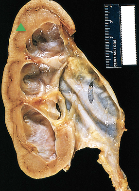 <p>What pathology is indicated by this image?</p>