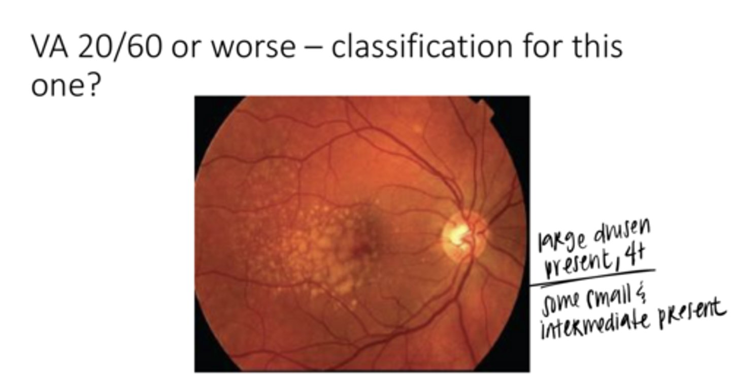 <p>What form of AMD is this pic?</p>