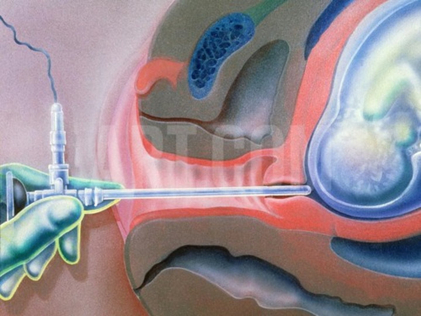 <p>instrument for visual exam of the fetus and amniotic fluid</p>