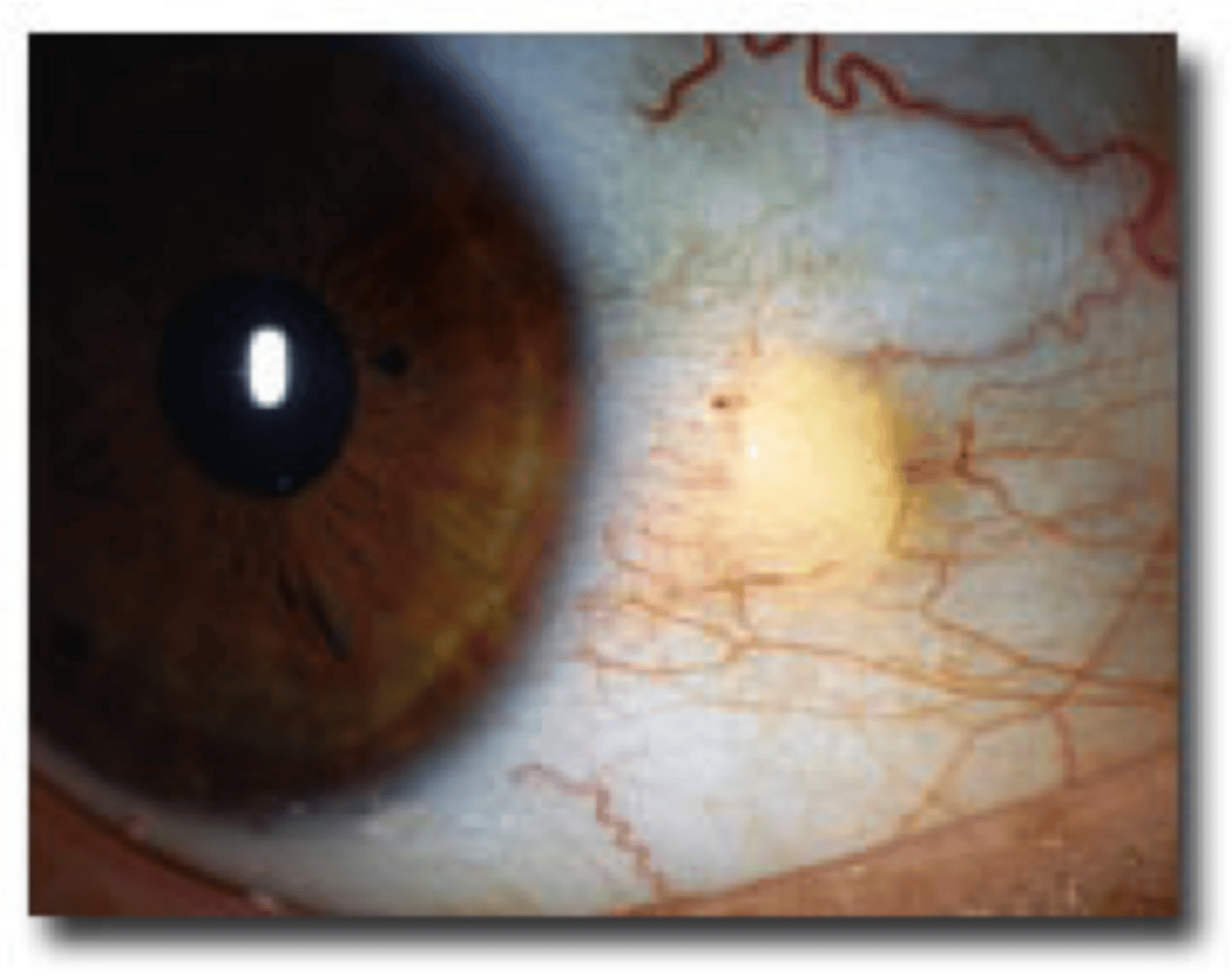 <p>harmless, yellowish white bump that develops on the white part of the eye</p>