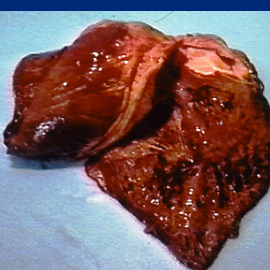 <ul><li><p class="has-focus">inflammation and damage to a horse's heart muscle</p></li><li><p><span style="color: rgb(136, 136, 136);"><strong>Et:</strong></span><strong> I<u>nfluenza</u></strong><u>, bacti,</u> parasitic, <u>toxins #1 (</u><strong><u>Ionophores</u></strong><u>,</u> venom, <u>plants</u>), IM, thromboembolic</p></li><li><p><span style="color: rgb(136, 136, 136);"><strong>Cs:</strong></span><strong> </strong><u>weakness, exercise intolerance</u>, cough, dyspnea,<u> tachycardia,</u> weak pulses, fever</p></li><li><p><span style="color: rgb(136, 136, 136);"><strong>Dt:</strong></span><strong> </strong><u>High CK, </u><strong><u>high cardiac troponin,</u></strong> echo w/ poor contractility or abnormal motion, Stomach contents exam&nbsp;</p></li><li><p><span style="color: rgb(136, 136, 136);"><strong>Tx:</strong></span> <u>Rest,</u> furosemide, digoxin, benazepril, lidocaine, MgSO4, <u>antibiotics, lavage,</u> charcoal, mineral oil, smectite, <u>Antivenom, Corticosteroids</u></p><ul><li><p><u>Prognosis guarded</u></p></li></ul></li></ul><p></p>