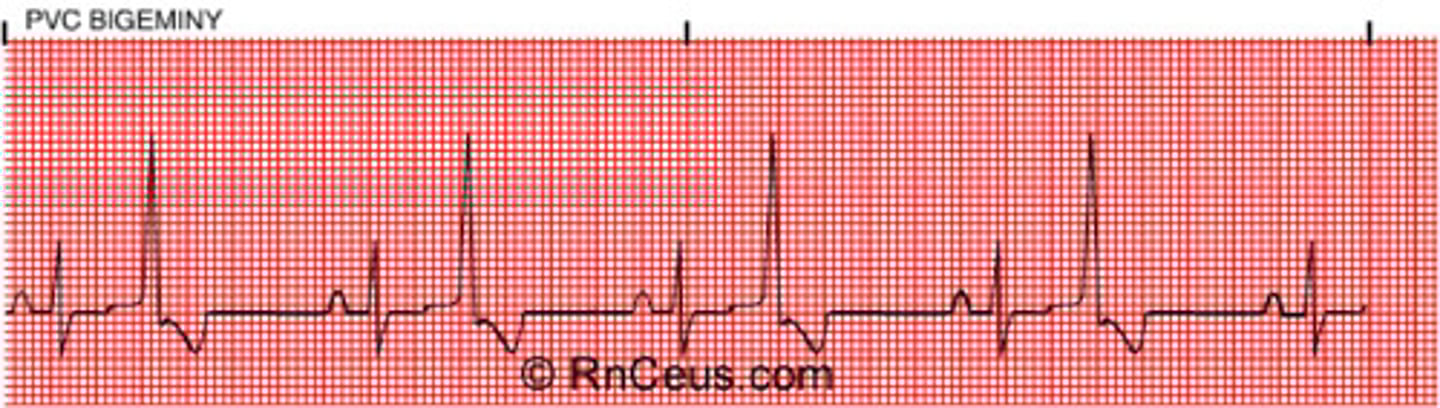 <p>Wide QRS</p><p>- may be unifocal or multifocal</p><p>- will have compensatory pause</p><p>- irreg rythm PVCs may be bigeminy, trigeminy, or quadrigeminy</p><p>- "run of" PVCS</p><p>- 3+ PVCs = Vtach!</p>