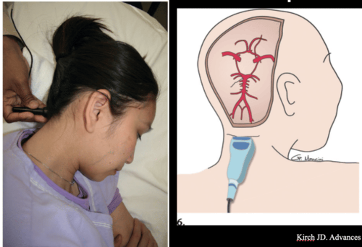 <p>Through foramen magnum</p>