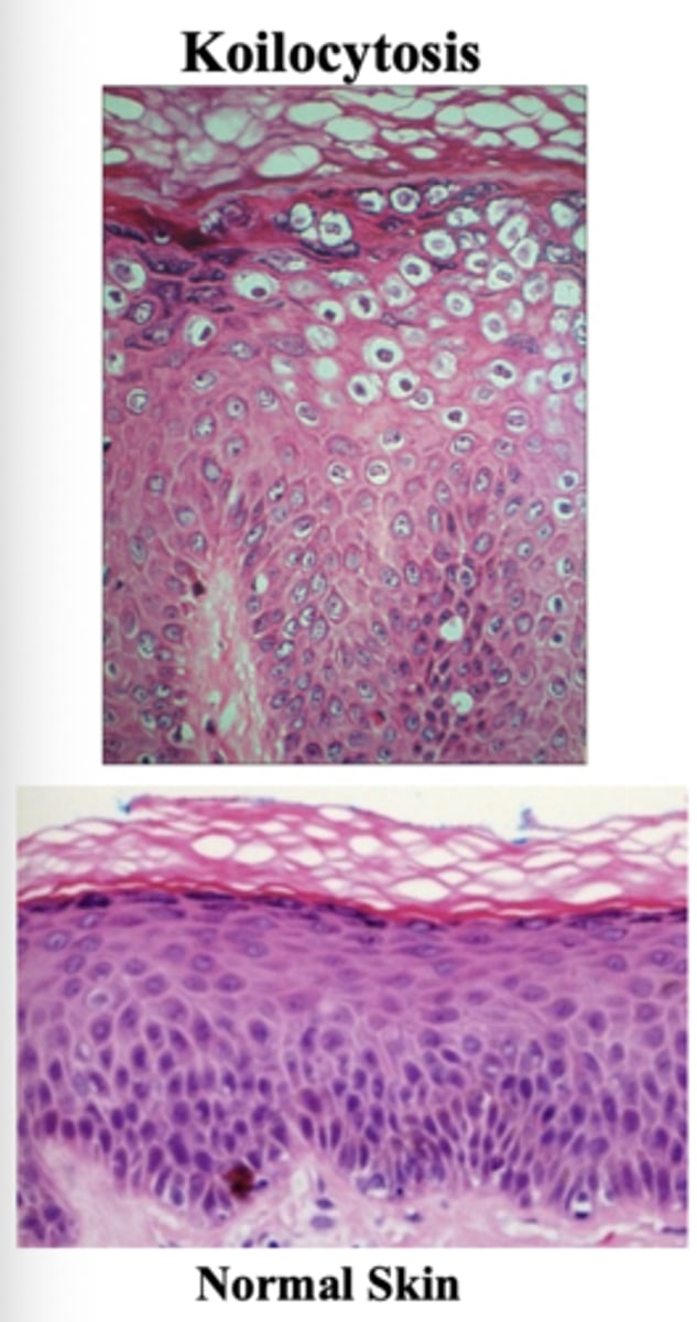 <p>- Nuclear enlargement</p><p>- Irregulatiry of the nuclear membrane contour</p><p>- Darker than normal staining nucleus</p><p>- Clear area around the nucleus</p><p>- Sloughed or scraped off koilocytes can be used for identification of low grade HPV lesion by pap smear</p>