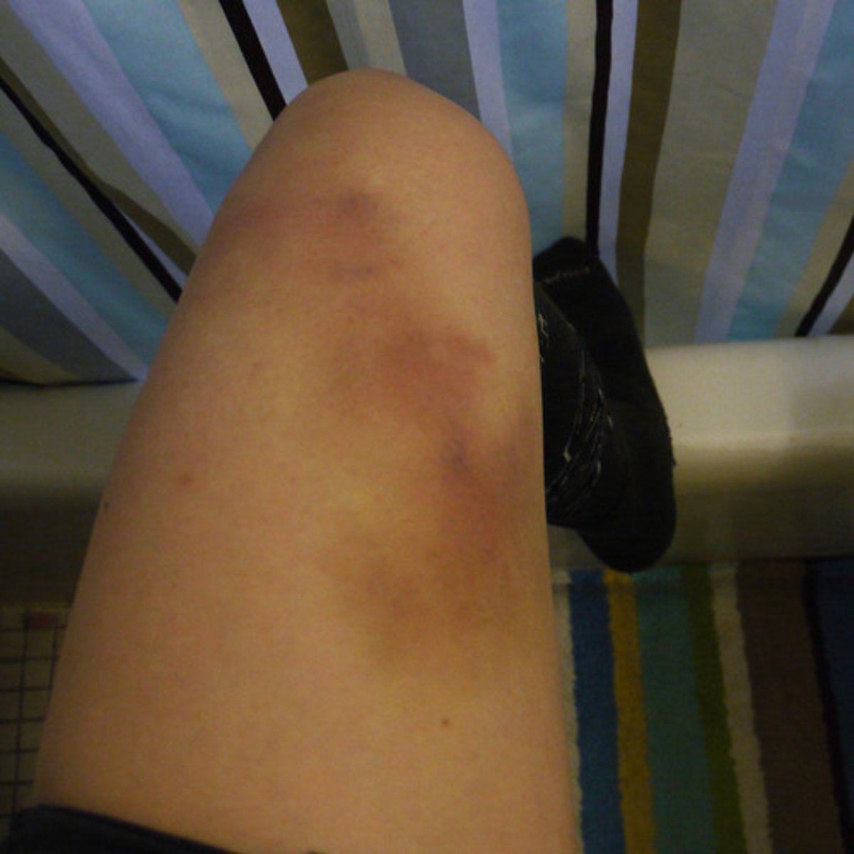 <p>синець,забите місце(an injury or mark where the skin has not been broken but is darker in colour, often as a result of being hit by something - covered in bruises His arms and back were covered in bruises.)</p>