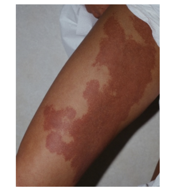<p>What is KTW syndrome </p>