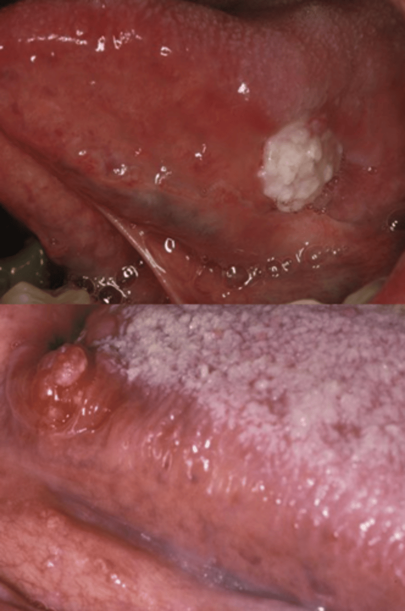 <p>1. Tongue (50%) 2/3 are painless</p><p>--Posterolateral</p><p>--Ventral</p><p>2. Floor of mouth</p>
