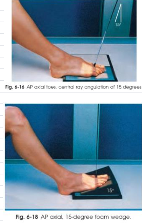 <p>RP: 3rd MTP joint</p><p>SS: Phalanges, Distal portion of metatarsals</p><p>CR: ⟂ (if 15 ° foam wedge is used) / 15 ° posteroinferiorly</p>