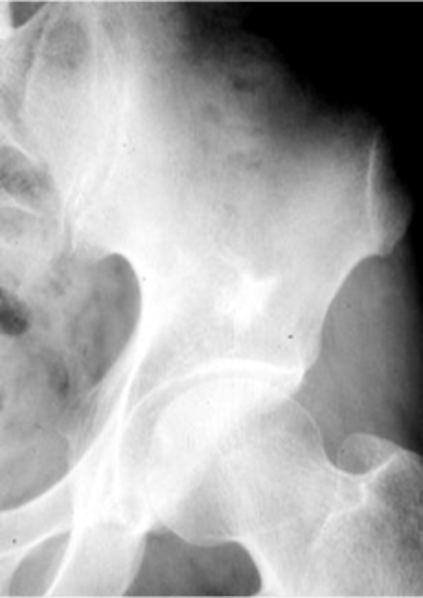 <p>Normal tissue in an abnormal area</p>