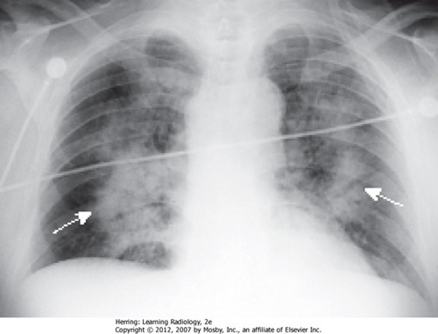 <p>- bilateral Pleural effusions</p><p>- enlarged heart</p><p>- pulmonary vascular markings</p>