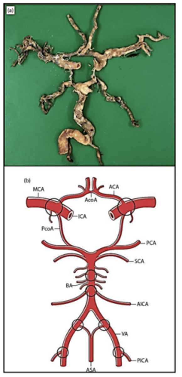 <p>vessels in Circle of Willis = at risk of large artery atherosclerosis</p>