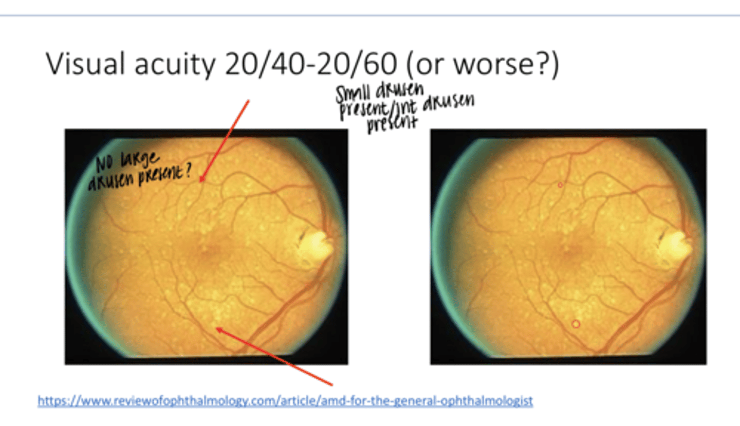 <p>Visual Acuity is 20/40-20/60. What is the classification of this AMD? (See Pic)</p>