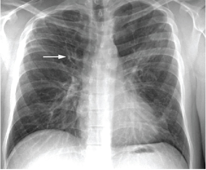 <p>What might you see on a CXR for bronchiectasis</p>