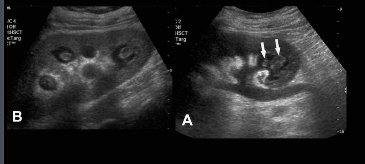 <p>What does the following describe?</p><p><span>• Ischemia of medullary pyramids</span><br><span>• Sloughed papilla in urine may be painful and cause ureteric obstruction, but makes clinical diagnosis</span></p>