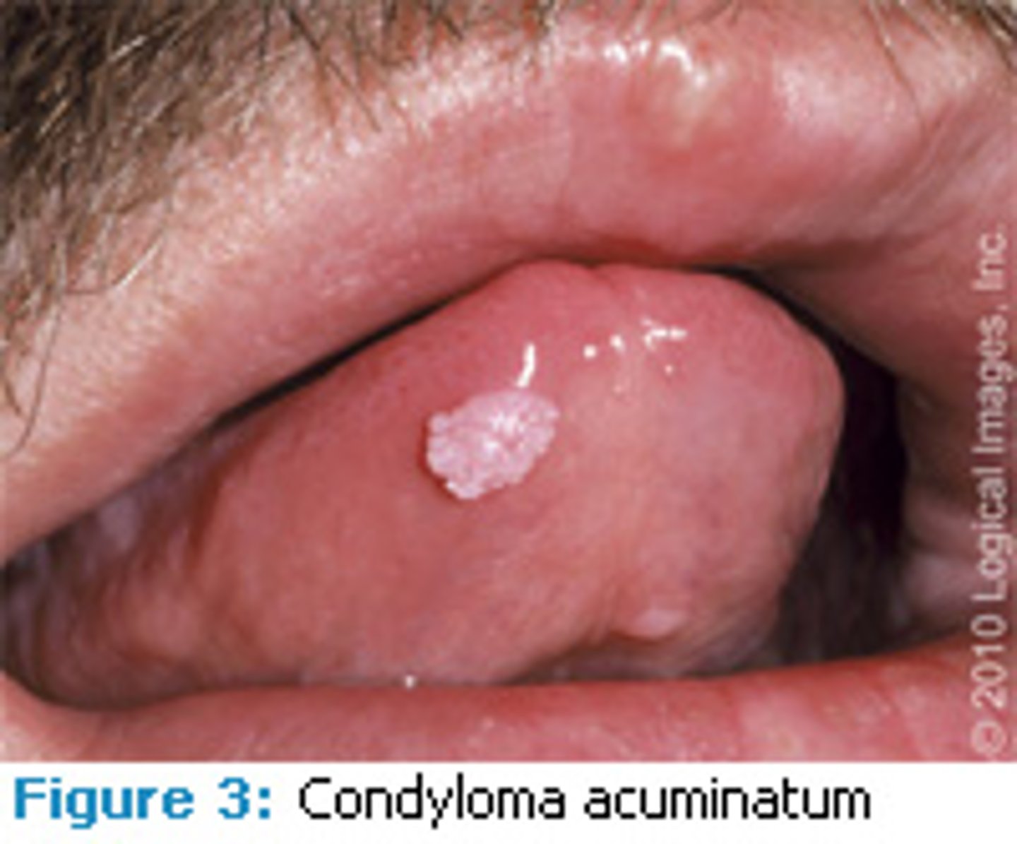 <p>wart-like growths</p>