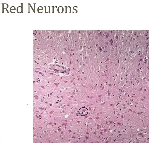 <p>-4-5 minutes; more</p><p>-12 hours; 12-24 hours; neurons; deep pink/red; “red neurons”</p><p>-liquefactive necrosis</p><p>-cysts; gliosis; wall; cyst</p>
