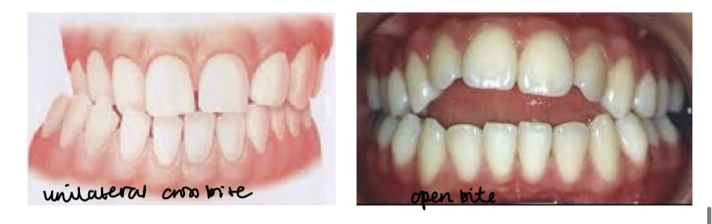 <p>Unilateral cross bite vs anterior open bite </p>