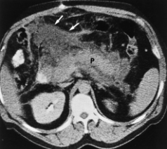 <p>Acute pancreatitis - diffuse enlargement with fatty obliteration </p>