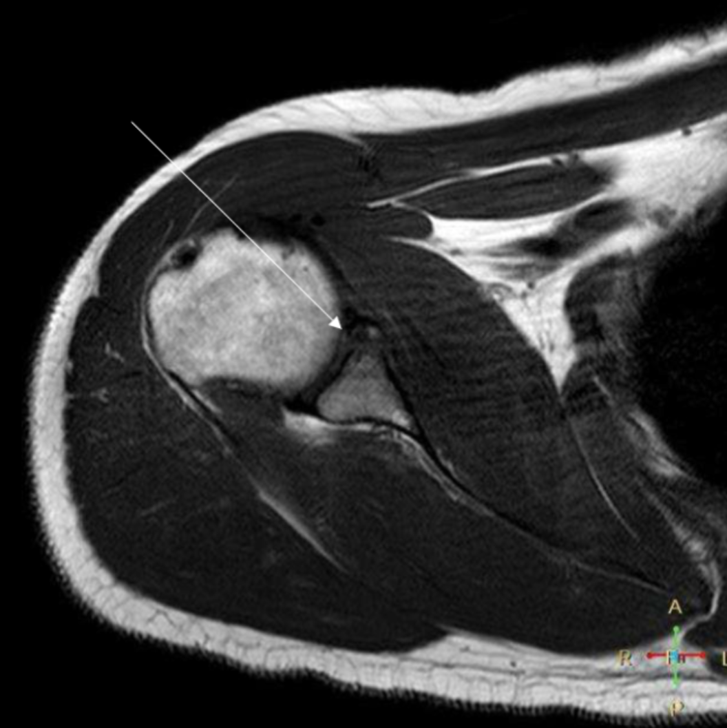 <p>Describe the pathology indicated by the arrow (Ax T1). </p>