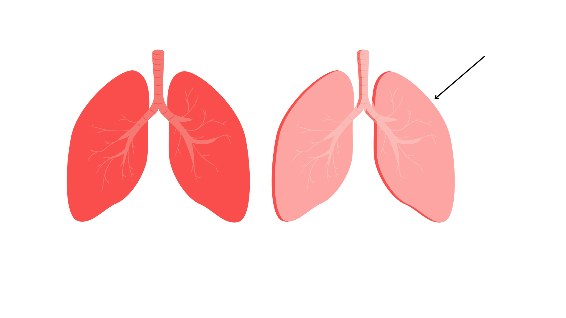 <p>Visceral pleura</p>