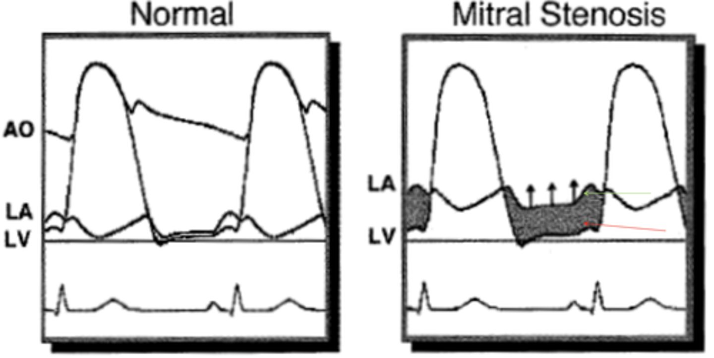 <p>Increased LA pressure</p><p>Decreased LV pressure</p>