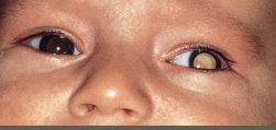 <p><strong>Retinoblastoma: Symptoms and Diagnosis </strong></p><p>-Symptoms</p><ul><li><p>Unilateral or bilateral</p></li><li><p>_________ (white reflex) → most common finding</p></li><li><p>Strabismus, ________ eye, limited vision </p></li></ul><p>-Diagnosis</p><ul><li><p>Full ophthalmologic exam</p></li><li><p>__ or orbits </p></li><li><p>Metastatic studies of bone marrow _________, LP, bone scan, ____</p></li></ul><p></p>