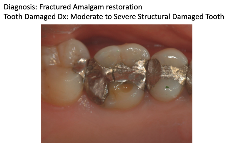 <p>what treatment should be done for this tooth?</p>