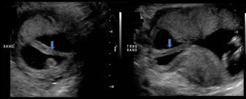 <p><strong>Asherman</strong> syndrome is related to what 2nd trimester OB finding</p><p>.</p><p>a) uterine synechia</p><p>b) limb body stalk</p><p>c) skeletal dysplasia</p><p>d) increased thickness of nuchal skin fold</p>