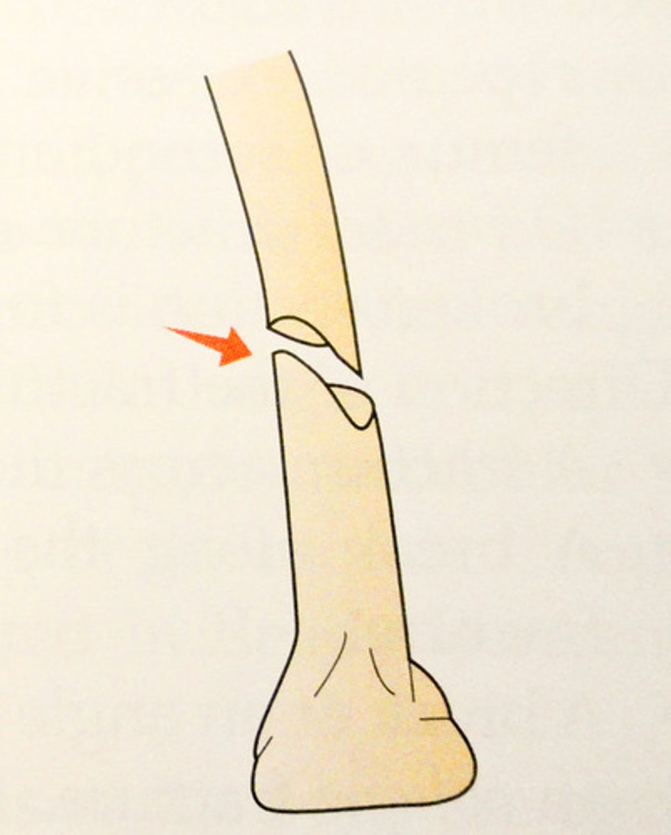 <p>ragged break occurs when excessive twisting forces are applied to a bone</p>