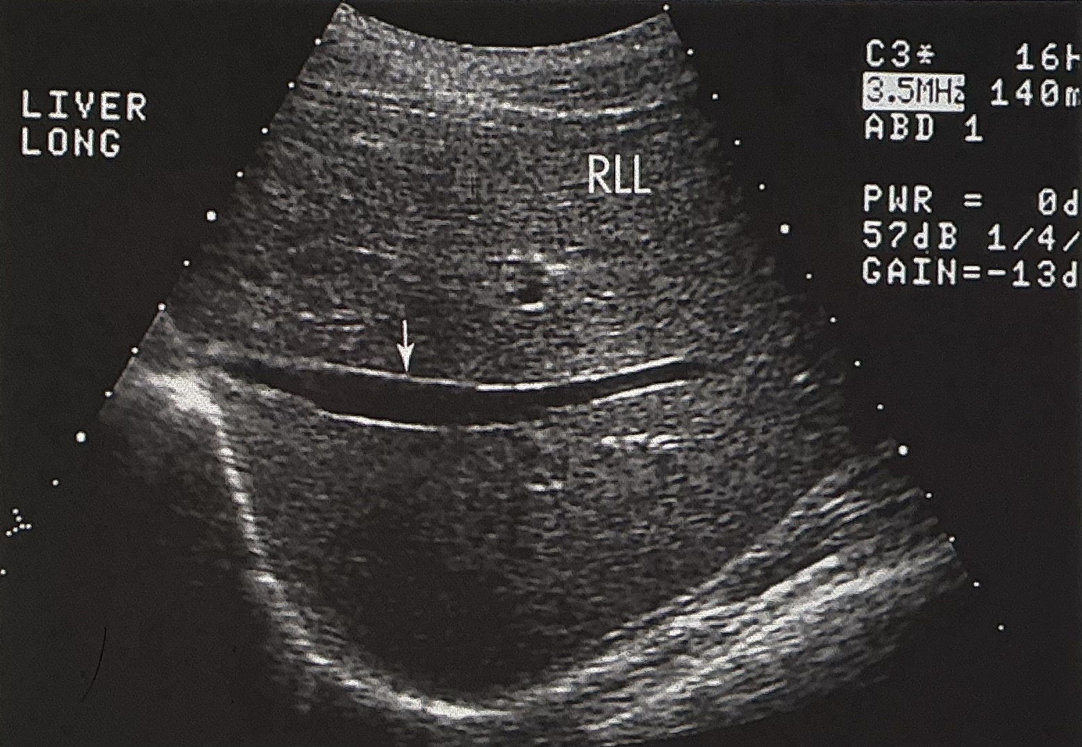 <p>Name and describe this image: Include scan plane, and name the structure identified by the white arrow.</p>