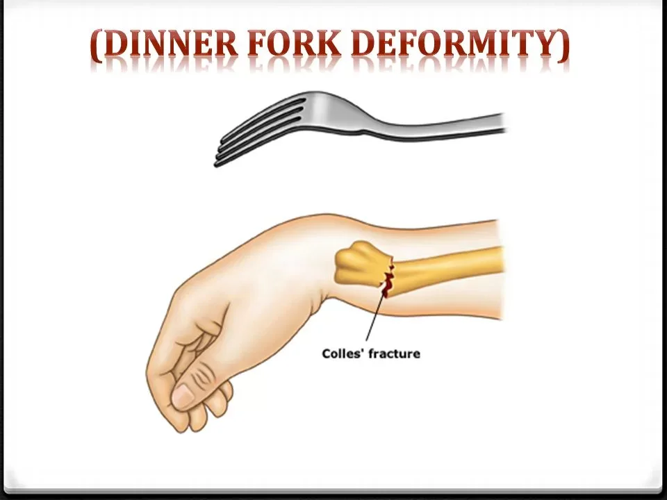 <p>Characteristics:</p><ul><li><p>Fracture of distal radius d/t FOOSH or blow to palmar side of wrist</p></li><li><p>Fragment displaced in dorsal and posterior direction</p></li><li><p>“Dinner fork” deformity</p></li><li><p>“Call me back for dinner”</p><ul><li><p>Call = colles</p></li><li><p>Back = dorsal/posterior</p></li><li><p>Dinner = dinner fork</p></li></ul></li></ul><p>Presentations:</p><ul><li><p>Wrist pain, swelling, and deformity</p></li><li><p>Limited ROM</p></li><li><p>Tenderness over distal radius</p></li></ul><p>Complications:</p><ul><li><p>Complex regional pain syndrome</p></li><li><p>Decreased grip strength</p></li><li><p>Loss of ROM</p></li><li><p>Extensor pollicis longus tendon tear</p></li></ul><p></p>