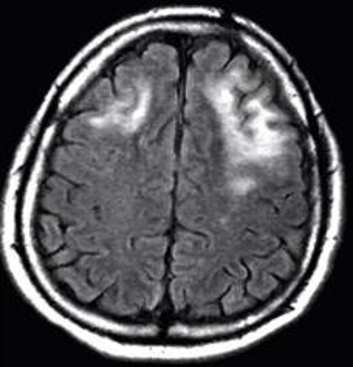 <p>Progressive multifocal leukoencephalopathy (PML)</p><p>- JC virus, human polyomavirus</p><p>- cortical white matter</p><p>- survival 6 mo. post dx.</p>