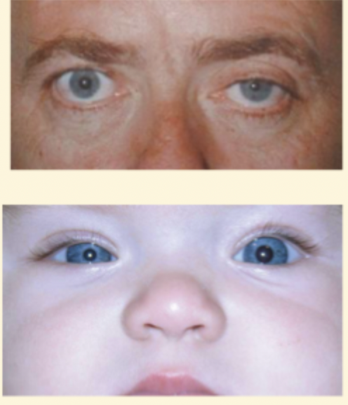 <ul><li><p>Miotic → more noticeable in dim light</p></li></ul><p></p>