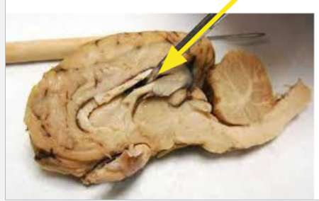 <p>Huge opening Below Corpus Callosum</p>