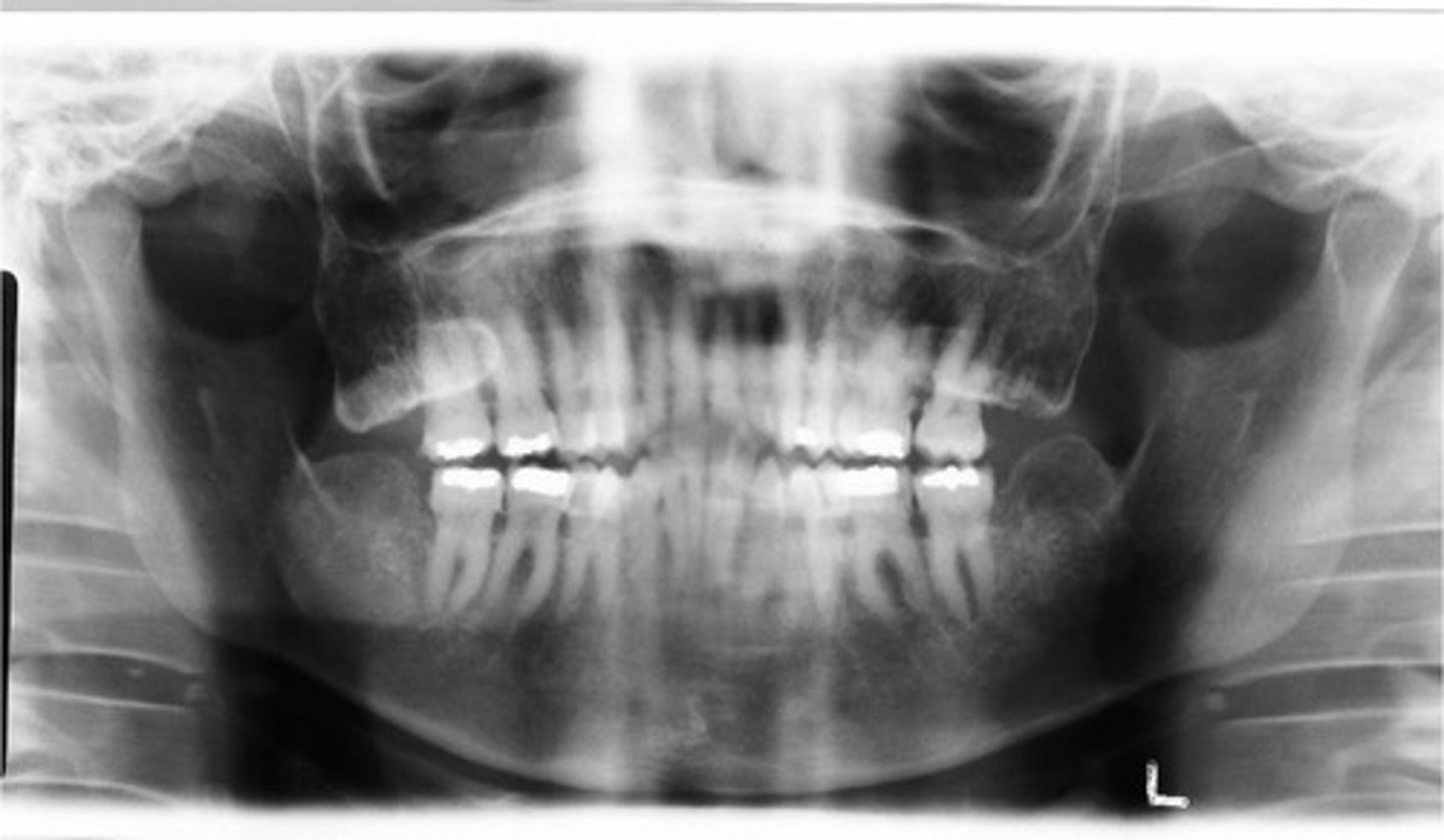 <p>What error caused the anterior teeth appear skinny and blurred?</p>